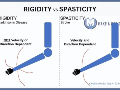 rigidity