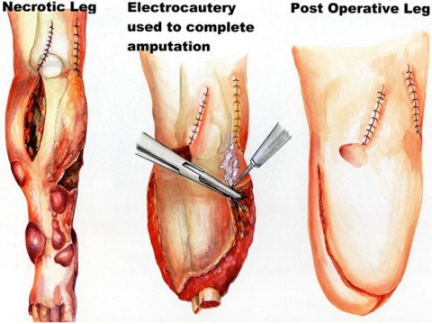 amputate