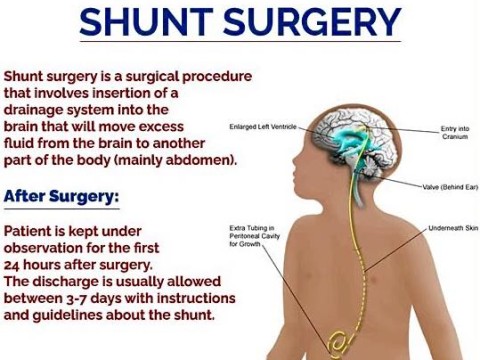 shunt