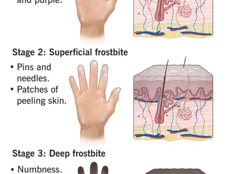 frostbite