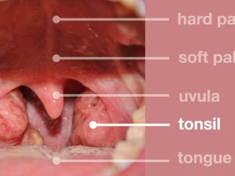 tonsil