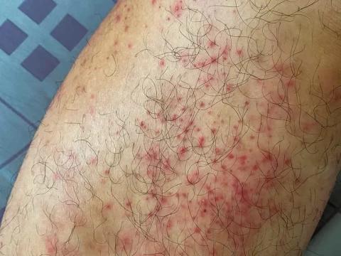hives