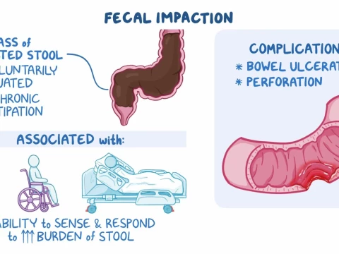 impaction