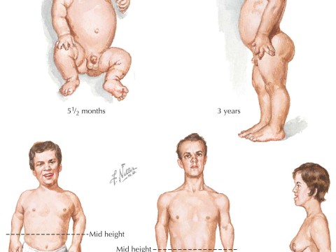 dwarfism