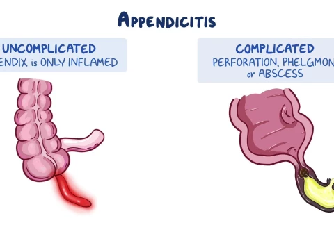 appendicle