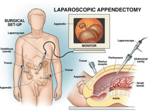 appendicectomy