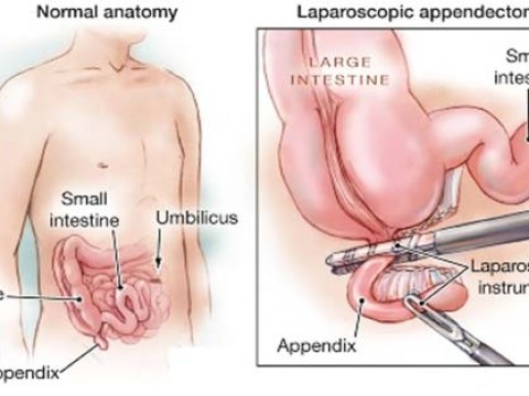 appendectomy