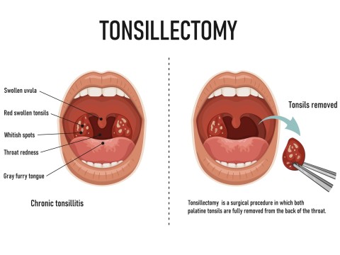 tonsillectomy
