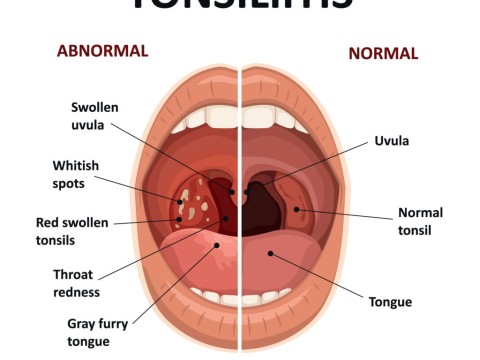 tonsillitis