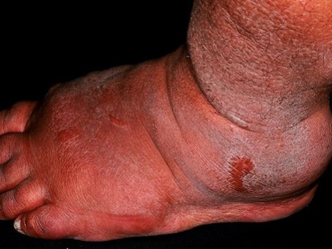 myxoedema