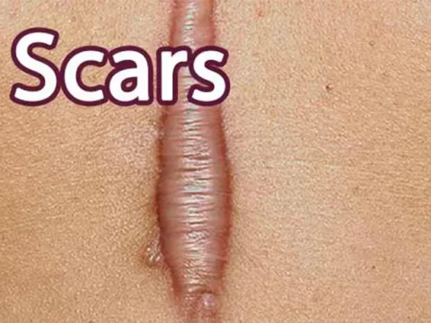 scar