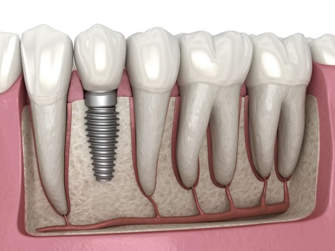 implant