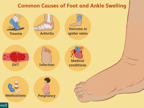 swelling