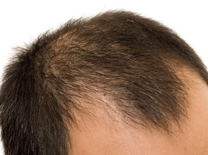 balding