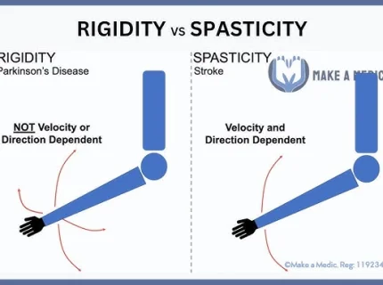 rigidity