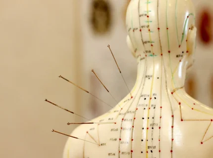 acupuncture