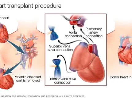 transplantation