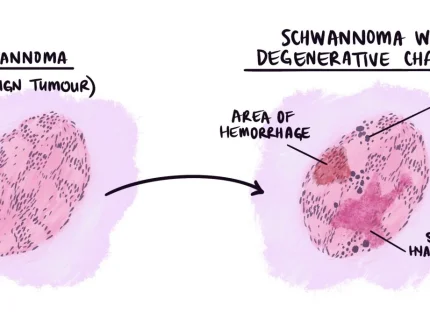 degeneration