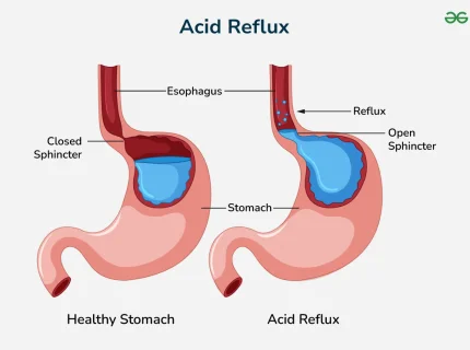 acidity