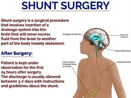 shunt