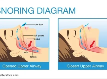 snorer
