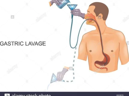 lavage