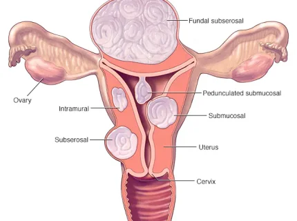 fibroid