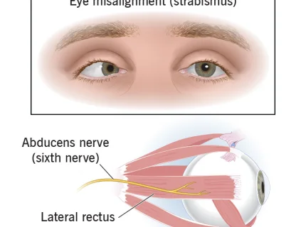 abducens