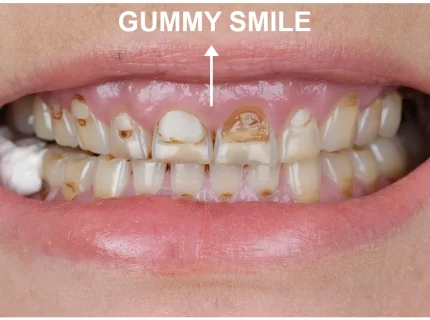 gumminess
