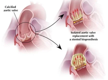 homograft