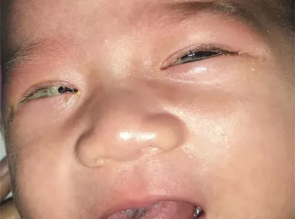 ophthalmia