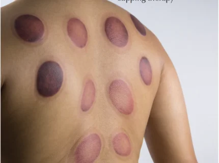 cupping