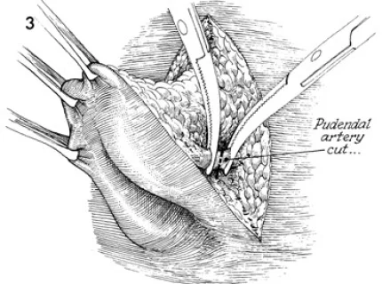 vulvectomy