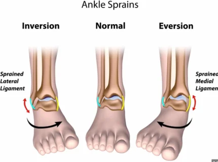 sprain
