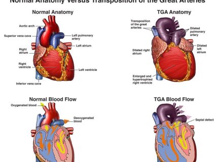 transposition