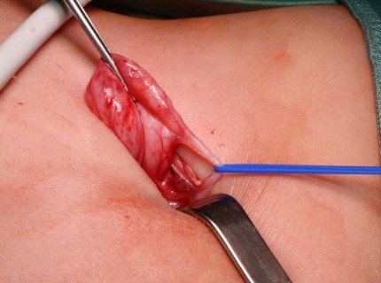 exteriorise