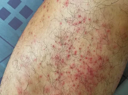 hives