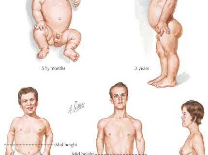 dwarfism