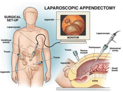 appendicectomy
