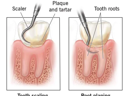 scaler