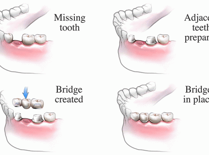 bridgework
