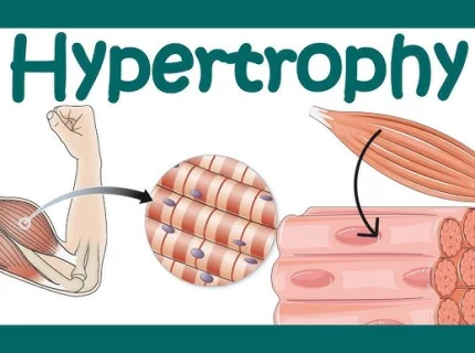 hypertrophy