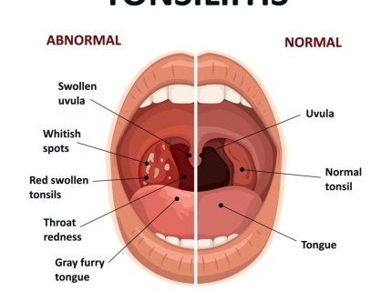 tonsillitis