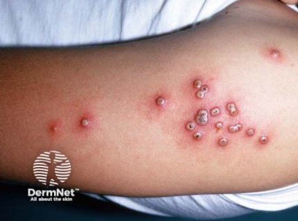 vaccinia