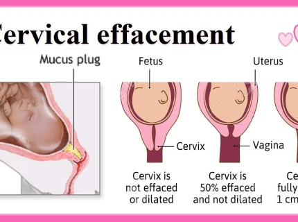 effacement