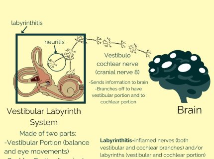 neuritis