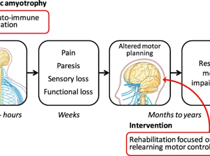 neuralgic