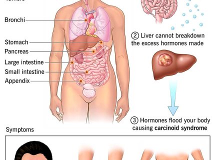 carcinoid