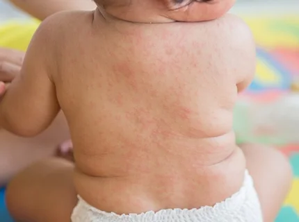 roseola