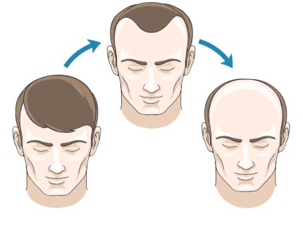 receding